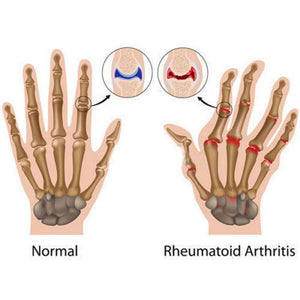 Copper Compression Arthritis Gloves Therapeutic Gloves for Men and Women, Support and Improve Motion Range